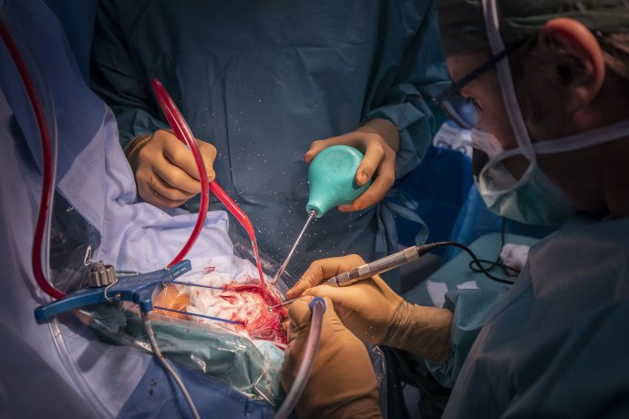 Operace mozku v Nemocnici Na Homolce. Foto: Gabriel Kuchta, Deník N