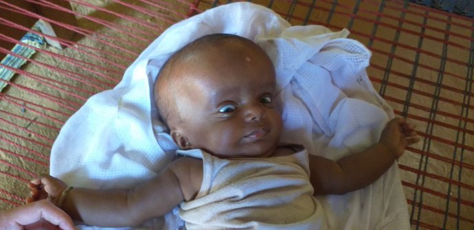 Súdánský chlapec Ez-Záki. Súdánský chlapec Ez-Záki se narodil s vodnatelností lebky. Foto: Pavel Onderka