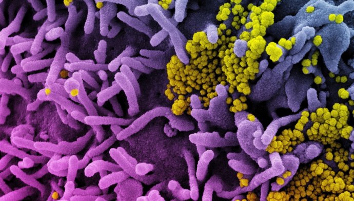 Buňka (fialová) napadená koronavirem SARS-CoV-2 (žlutá). Foto: NIAID via Latin America News Agency via Reuters Connect