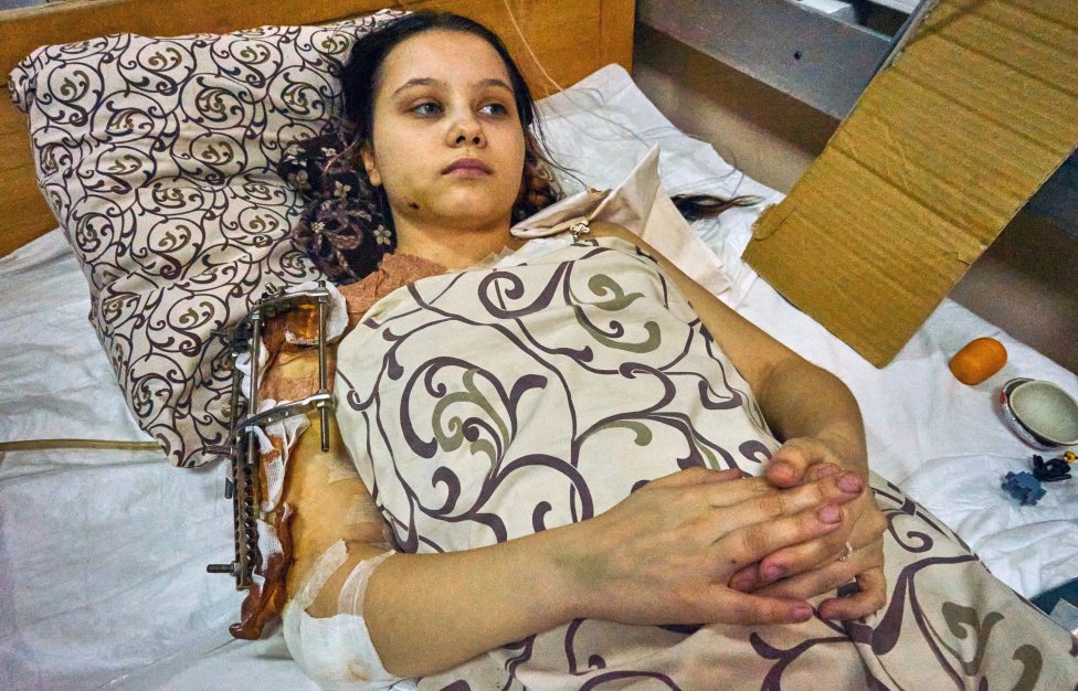 Máša Fešenkovová byla zraněna 13. března ve své rodné vesnici Polohy v Záporožské oblasti. Foto: Iva Zímová