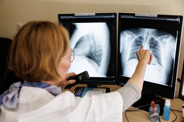 Lékařka kontroluje rentgen plic kvůli možné tuberkulóze. Ilustrační foto: ČTK/DPA/Matthias Balk